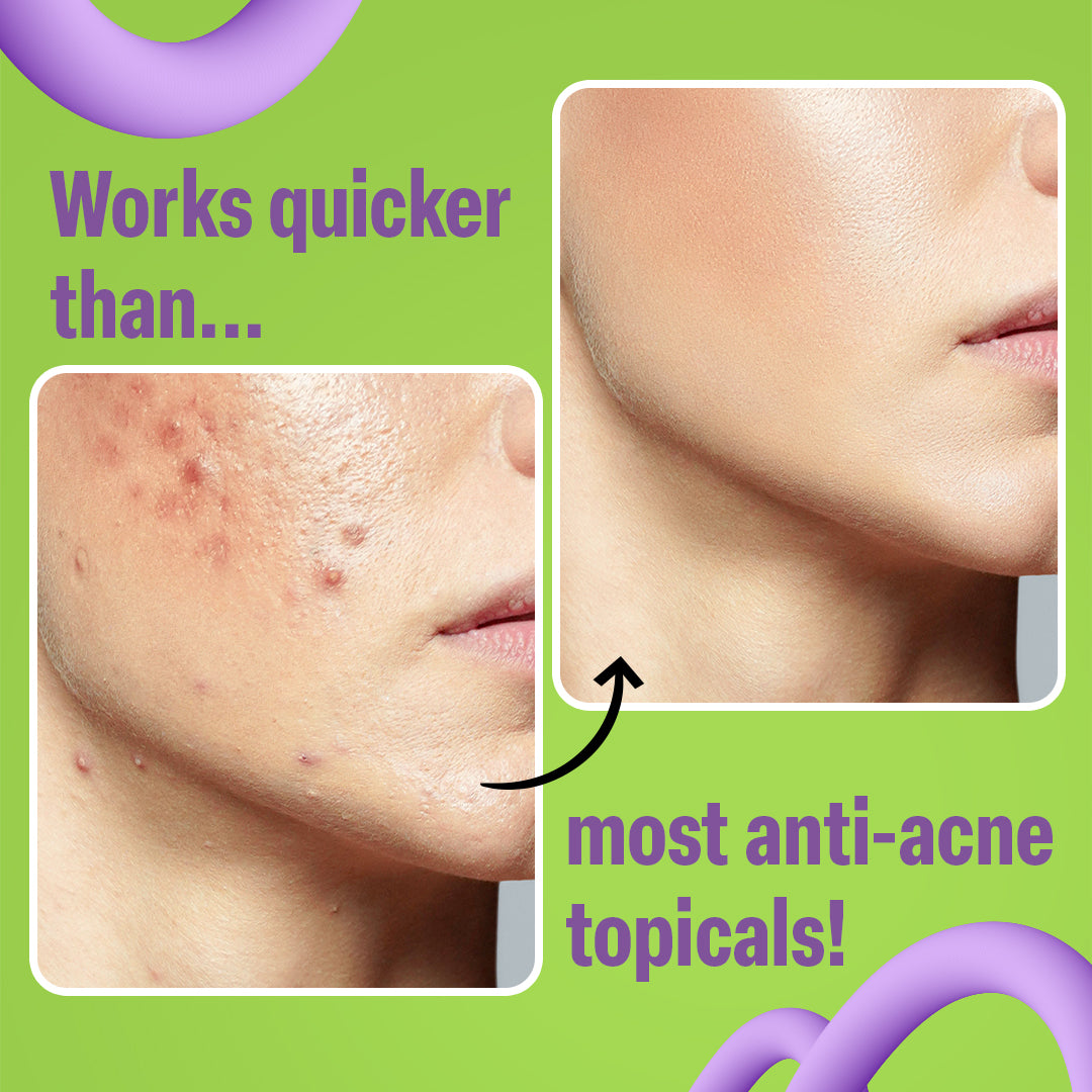NXTFACE 3% Zinc Sebum - Clarifying Serum | 30ml image 5
